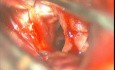 Anévrisme Cérébral - Anévrisme Choroïdien Antérieur - Clipping Micro-chirurgical