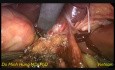 Ablation du kyste du conduit cholédoque par voie laparoscopique