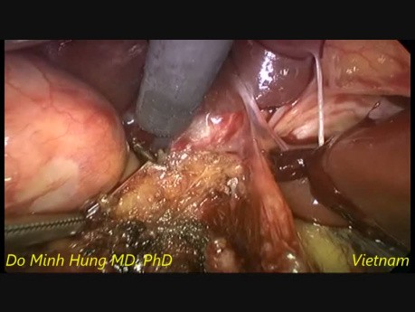 Ablation du kyste du conduit cholédoque par voie laparoscopique