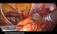 Réparation Transabdominale d'une Hernie Inguinale Prépéritonéale chez la Femme