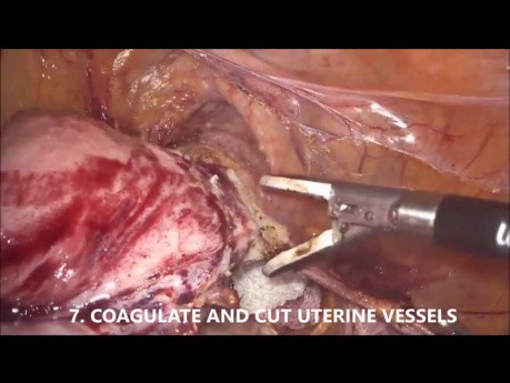 Technique d'hystérectomie laparoscopique de Goel (vidéo non éditée d'une heure, 10 étapes pour une chirurgie sûre)