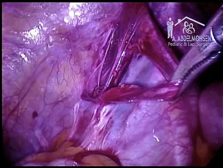 Varicocélectomie laparoscopique