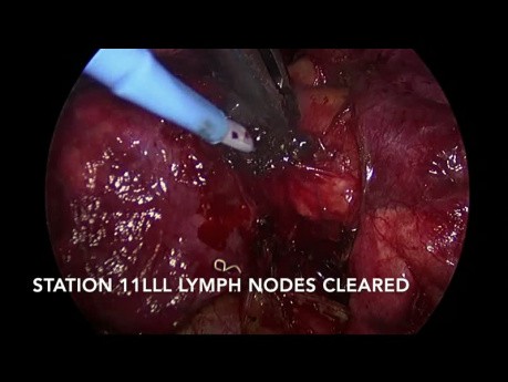 Chirurgie thoracique vidéo-assistée: Lobectomie inférieure du poumon gauche en raison d'un cancer non à petites cellules