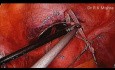Cerclage du col utérin par laparoscopie en raison d'incompétence ou insuffisance cervicale