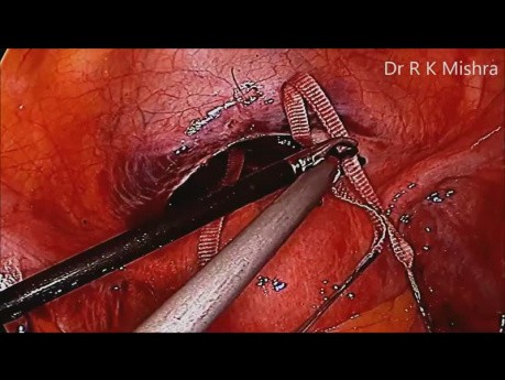 Cerclage du col utérin par laparoscopie en raison d'incompétence ou insuffisance cervicale