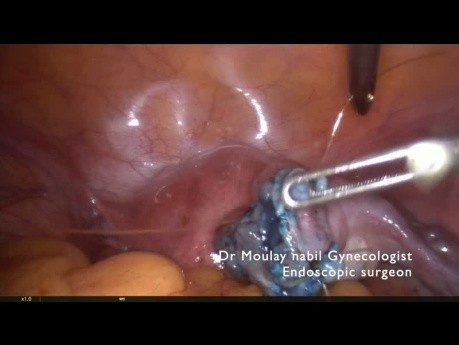 Salpingoplastie laparoscopique