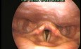 Vue endoscopique avant et après la chirurgie - Polype des cordes vocales, partie II