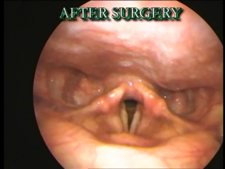 Vue endoscopique avant et après la chirurgie - Polype des cordes vocales, partie II