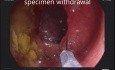 Résection Assistée par Clip d'un Polype du Segment Inférieur du Côlon