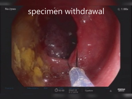 Résection Assistée par Clip d'un Polype du Segment Inférieur du Côlon