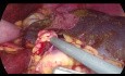 Splénectomie laparoscopique chez un patient présentant une agénésie du pancréas dorsal - Vaisseaux d'abord technique