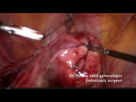 Contrôle Vasculaire Transitoire et Myomectomie
