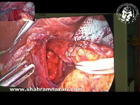 Fundoplicature Laparoscopique de Nissen et Herniorraphie Hiatale après l'échec de l'AMAR