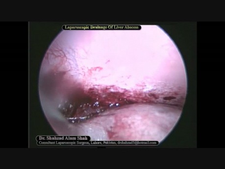 L'abcès hépatique - drainage laparoscopique