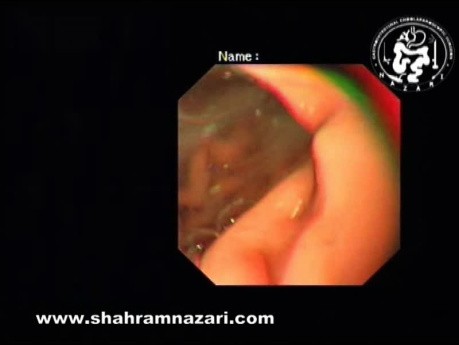 Observations Endoscopiques Classiques de l'Achalasie