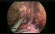 Colectomie gauche par laparoscopie, étape par étape