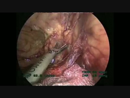 Colectomie gauche par laparoscopie, étape par étape
