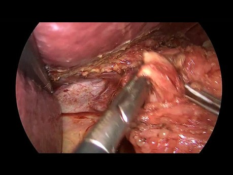 Reprise de Fundoplicature Nissen Après Ouverture de Valves