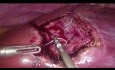 Technique de résection hépatique non anatomique par laparoscopie - "Diamond Technique"