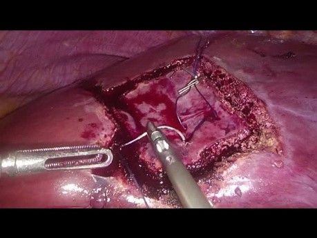 Technique de résection hépatique non anatomique par laparoscopie - "Diamond Technique"