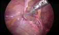 Traitement laparoscopique de la hernie hiatale chez un enfant