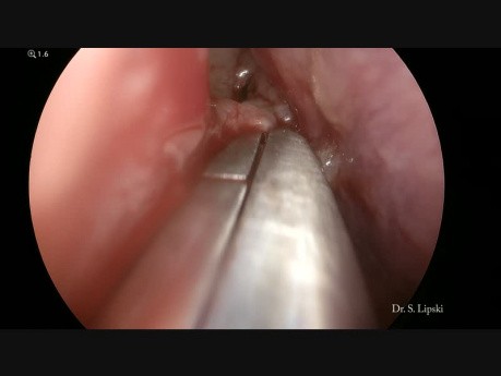 Résection d'un polype antrochoanal droit
