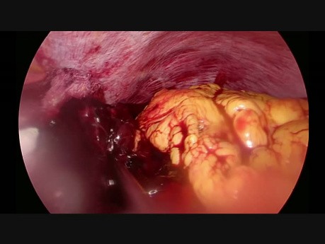 Saignement après gastrectomie laparoscopique