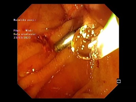 Ampullectomie Partie 4 - Deux Mois Après