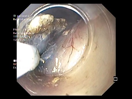 Dissection Sous-Muqueuese Endoscopique Oesophagienne