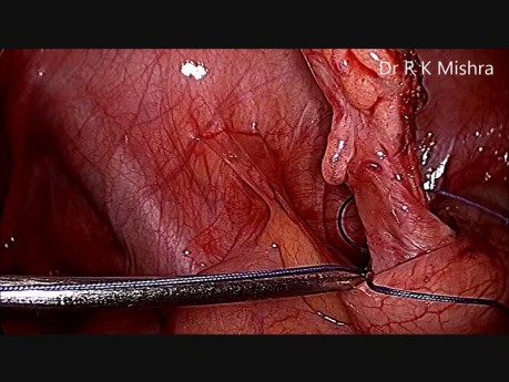 Appendicectomie laparoscopique