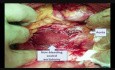 Perforation de l'aorte pendant la laparoscopie