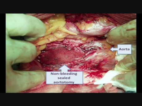 Perforation de l'aorte pendant la laparoscopie