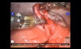 Ablation d'un kyste ovarien assistée par robot da Vinci