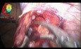 Chirurgie Coelioscopique de la Varicocèle Conservatrice de l'Artère