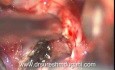Kyste Colloïde du 3e Ventricule - Excision Totale Microchirurgicale Transcorticale et Transventriculaire
