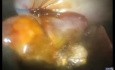 Évolution de la Cholécystectomie Laparo-Endoscopique à Site Unique (LESS) Sans Anesthésie Générale