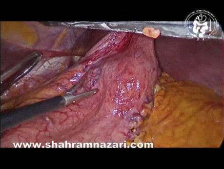 Résection Laparoscopique des GIST Gastriques
