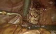 TLH avec Endométriose Recto-Vaginale