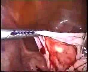 Traitement laparoscopique d'un kyste ovarien