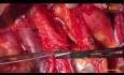 Curage Ganglionnaire Para-Aortique Chirurgie Ouverte
