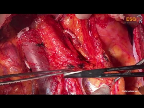 Curage Ganglionnaire Para-Aortique Chirurgie Ouverte