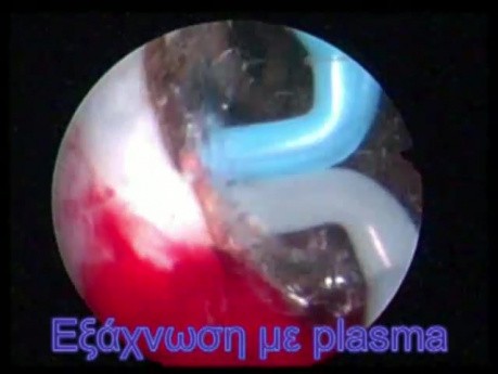 TURis plasma vaporisation