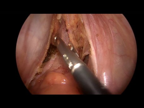 Rectopexie Postérieure Laparoscopique pour Prolapsus Rectal