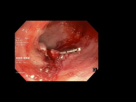 La polypectomie endoscopique avec placement des clips.