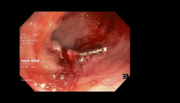La polypectomie endoscopique avec placement des clips. • Vidéo ...
