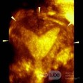 L'utérus cloisonné - L'échographie 3D