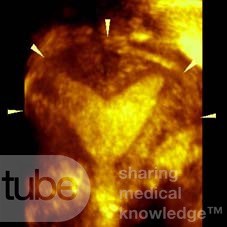 L'utérus cloisonné - L'échographie 3D