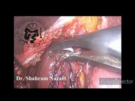 Cholécystectomie laparoscopique dans la vésicule biliaire contractée