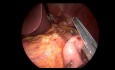 Dérivation gastrique (Bypass) Roux-en-Y après Gastrectomie Sleeve