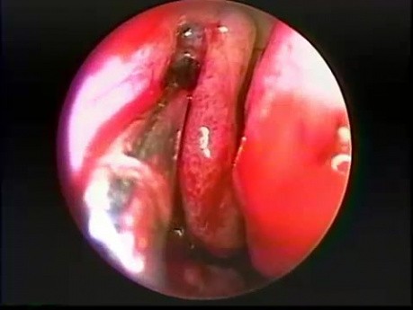 Antrostomie maxillaire par voie trans-nasale - endoscopie